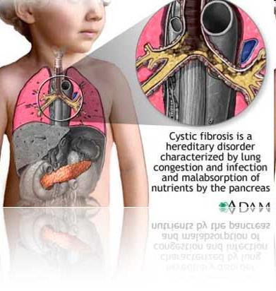 Cystic Fibrosis Cystic fibrosis is one of the most common inherited respiratory disorders in The U.S.