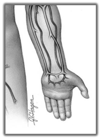 Radial Artery Thumb side of wrist Located by palpating pulse Ulnar artery Radial artery 2017 MFMER slide-7 Brachial Artery The advantage to using the brachial artery is that it is large and easy to