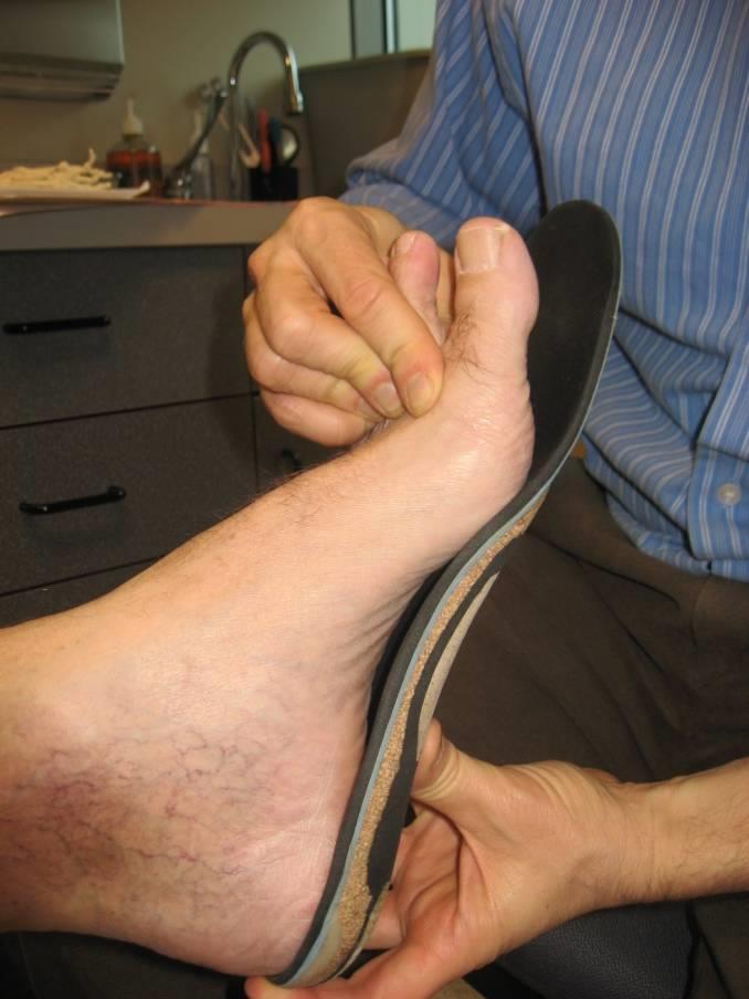 ,,,the orthoses which decreased plantar aponeurosis strain [had closer] surface contours of their