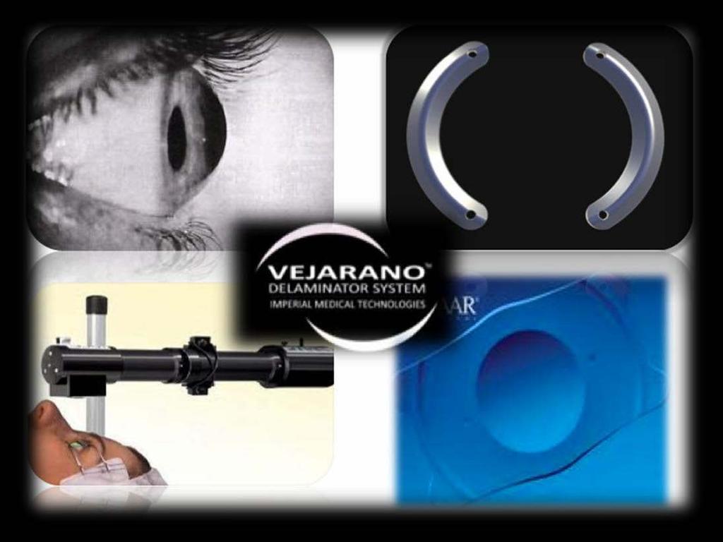 VEJARANO PROTOCOL Vejarano s Protocol objective for Keratoconus Treatment is to ensure the patients satisfaction. Dr.