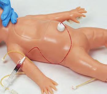 Adhesive tape will not adhere to the material of the face. Use an alternative method to secure the ET tube. 5. The baby may also be ventilated with a bag valve mask. D.