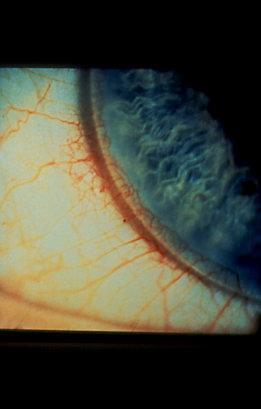What is not acceptable re centration Corneal exposure or edge continually passing