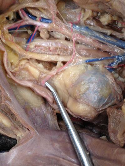 Notice the blue lump (the kidney) Notice the common iliac Notice were the artery exits the