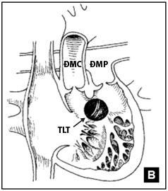 dưới van ĐMC [55],[56]. Lỗ TLT dưới hai van động mạch chiếm tỷ lệ khoảng 10% của tổng số bệnh nhân TPHĐR [1].