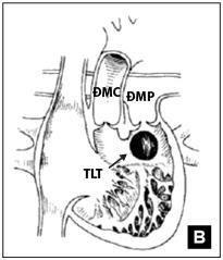 Trong trường hợp mào dưới van ĐMP tồn tại tạo thành bờ trên lỗ TLT, khoảng cách từ lỗ TLTtới van ĐMP tùy thuộc kích thước của mào dưới van ĐMP. Hình 1.7: TPHĐR thể chuyển gốc động mạch.