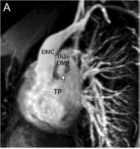 27 Hình 1.17: Hình ảnh MRI trong chẩn đoán TPHĐR. (A) Hình ảnh MRI của bệnh nhân TPHĐR kèm theo thông sàn nhĩ thất toàn bộ, hẹp phổi cùng với hội chứng đồng phân. (B) Hình ảnh chụp MRI đa dãy [45] 1.