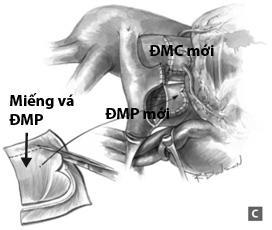 (A) ĐMV được bóc tách khỏi ĐMC lên (B) Sau khi trồng lại ĐMV,