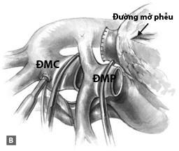 (C) Thân ĐMP được gắn vào mặt trước của đường mở phễu TP sau khi đường hầm trong tim hoàn tất.