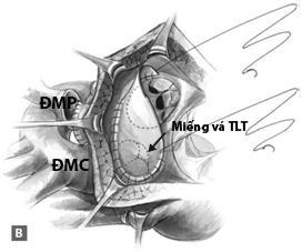 (C) ĐRTP được tái tạo lại bằng ống van ngoài tim [34] o Phẫu thuật Nikaidoh Phẫu thuật Nikaidoh được