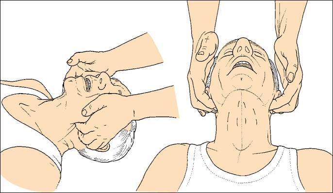 DO NOT extend the head backwards. If difficulty is encountered maintaining the airway in the horizontal position, tilt the infant s head back slightly with a gentle movement.