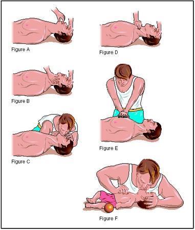 the airway, and when clear, roll casualty back and resume CPR.