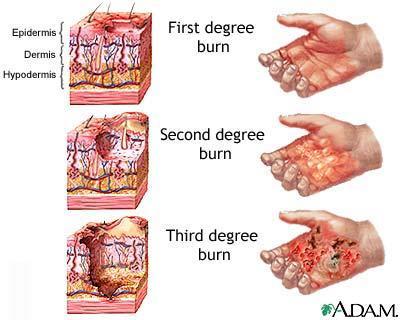 BURNS are caused by contact with flame, hot objects, chemicals, electrocution, radiated heat, frozen surfaces, friction or radiation. SCALDS are caused by contact with boiling fluids or steam.