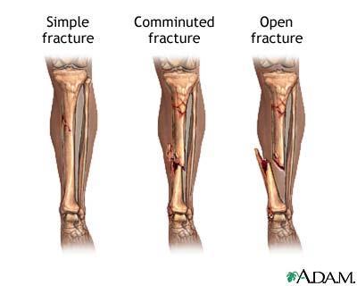 Module 8 Fractures Objectives After this module you should be able to Identify different types of fractures Define an open fracture Locate and name major bones of the extremities List the functions