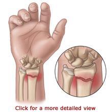 Fractures may be caused by a number of methods: DIRECT FORCE, where force is applied sufficiently to cause the bone to fracture at the point of impact.