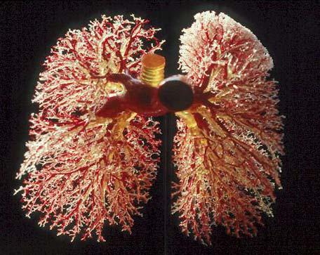 cast of pulmonary