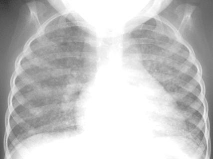 Not only Lung CT and thorax plain film are showing the pulmonary miliaris, the complementary head scan can also