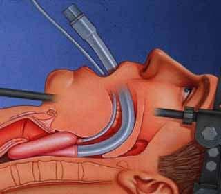 Since the LMA is considered a less adequate method to secure the airway, it will most likely only be used when the airway is more geographically accessible to the anesthetist, Figure 4.