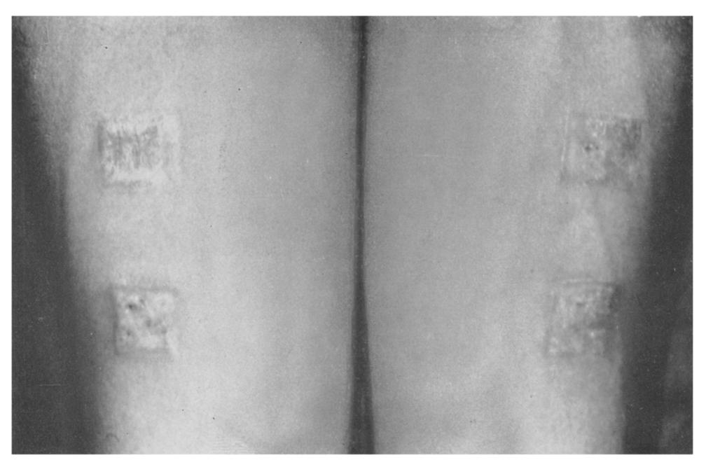 An hour after removal from the bath the degree of eedema was equal in the two burns (Fig. 2). FIG.