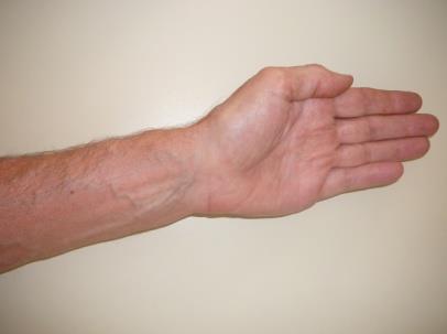 Chapter 3: Rotating the Forearms at the Elbow movement toward the thumb) or toward