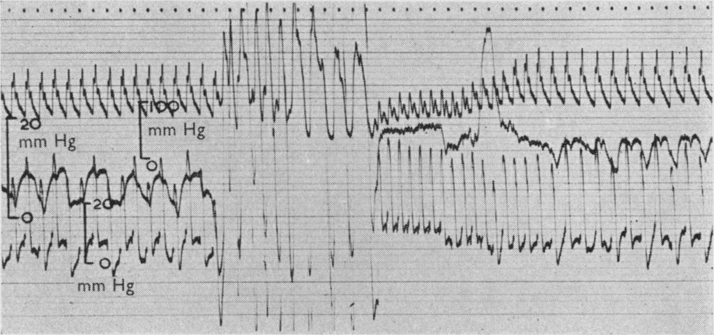 354 E. P. SHARPEY-SCHAFER latter procedure was followed by an immediate return of intrathoracic and cardiac pressures to control levels.