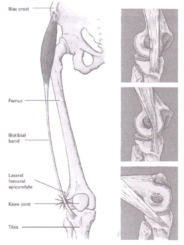 Figure 2: Illustration of Iliotibial Band and Lateral Femoral Epicondyle Contact during Knee Flexion.