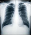 Silicosis Facts Permanent Irreversible No cure Worsens after exposure ends Deadly Silicotic Lung Photo: CDC Normal Lung
