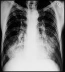 has long been known to cause silicosis, a disabling, non-reversible and sometimes fatal lung disease The Hawk's Nest