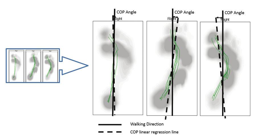 created by impact and reactive ground forces, but this is just one hypothesis. This is also the segment most affected by falling arches with visible medial shift of the COP gait line (Figure 8).