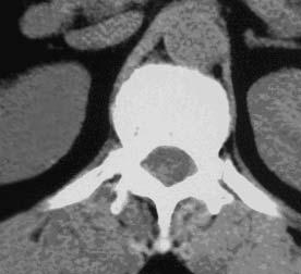 Note the persistent focal radioactivity in the right adrenal, as indicated by the arrow.