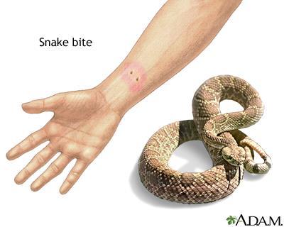 Snake Bites Nonpoisonous snake bites should be scrubbed with soap and water and have an antiseptic applied Poisonous snake bites Seek medical care ASAP so they can neutralize the venom Remove rings