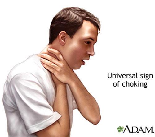 Choking If someone appears to be choking, ask if they can speak!