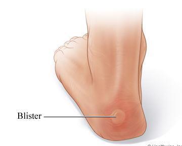 Blisters on the Hand and Foot Prevention is KEY!