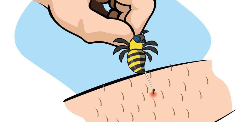 Bites and Stings Bees/Wasps Ticks Scrape away the stinger with the edge of a knife blade or credit card Squeezing it puts more venom into the skin Ice may reduce the pain and swelling PREVENTION Wear