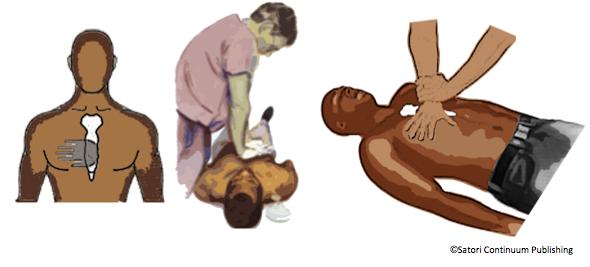 If you are not sure you feel a pulse, begin CPR with a cycle of 30 chest compressions and two breaths. 2.