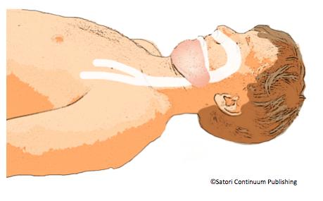 6. After 30 compressions, stop compressions and open the airway by tilting the head and lifting the chin. a. Put your hand on the victim s forehead and tilt the head back. b. Lift the victim's jaw by placing your index and middle fingers on the lower jaw; lift up.