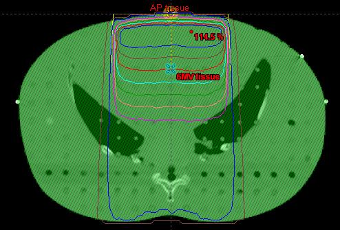 A dose reference point was selected to correspond with the centre of where the TLD plug was located for measurement during the treatment stage.