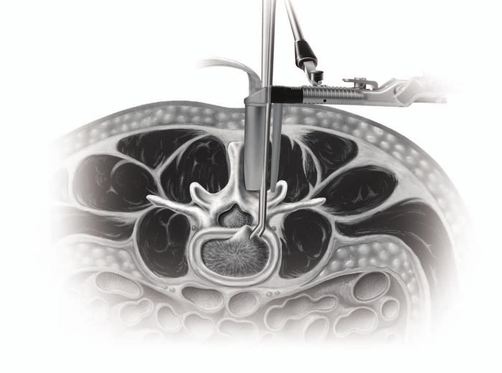 M A X I M U M A C C E S S S U R G I C A L P L A T F O R M MAXCESS DECOMPRESSION MaXcess provides the benefits of a minimally invasive approach without compromising the outcomes