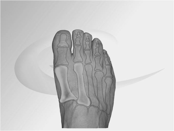 Corrections Foot Exercises Short foot Orthoses