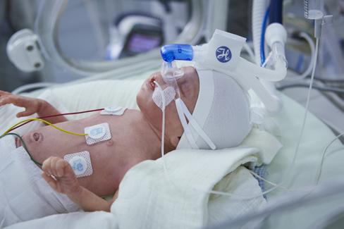 Neonatal ventilation Tidal volumes as low as 2 ml With the neonatal option, the HAMILTON-T1 provides tidal volumes as low as 2 ml for effective, safe, and lung-protective ventilation even for the