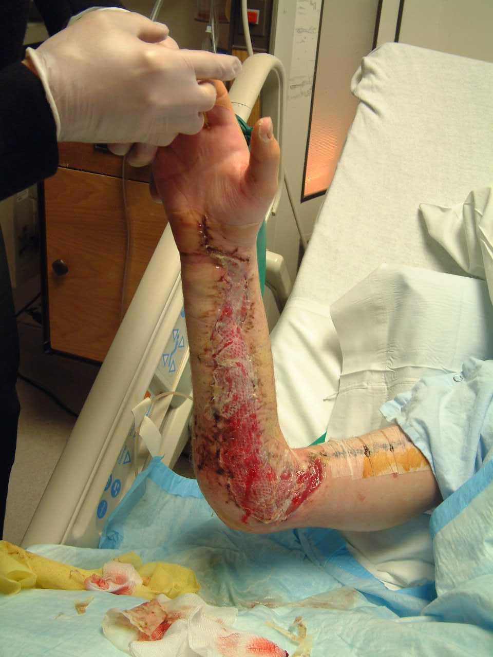 Case: Necrotizing Fasciitis Multiple surgeries to debride necrotic tissue, ICU support Six hyperbaric oxygen