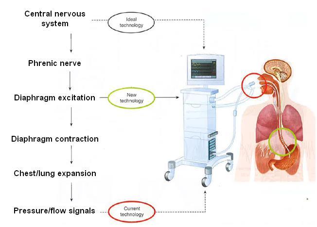 Neurally Adjusted Ventilatory Assist ideal NAVA other modes Sinderby in: