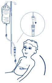 Vitality Medical 800-397-5899 catheter tip syringe or a gravity drip bag. Both methods are outlined below. 1. Attach a 60cc water filled catheter tip syringe to the Bolus Port.