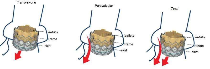 For a sealed valve, Total Leakage = Transvalvular Leakage For an