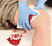 Controlling External Bleeding Expose, examine, and apply direct pressure to