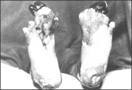 Trench Foot Infection of the feet Caused by cold, wet, & unsanitary conditions Men stood for hours in waterlogged trenches Feet would go numb Skin would turn red or blue