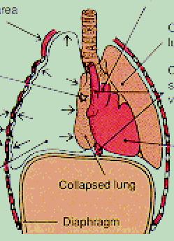 Troubleshooting When lung volume decreases, cycles speed up