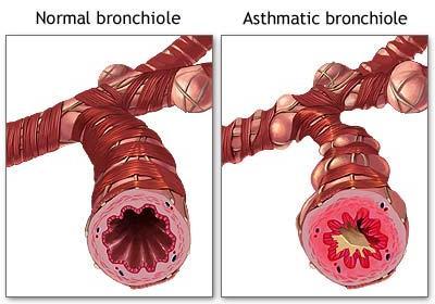 Asthma As bronchoconstriction worsens, pressure in airways increases Oxylator will cycle faster Results in