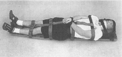 Figure 18.8 Complete cervical spine immobilization is required to prevent spinal injuries from being worsened during patient transfer. Figure 18.