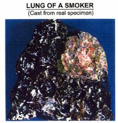 An inflammation of small air passages caused by infection is called 41. Do people exposed to smoke have a higher rate of this condition? 42.