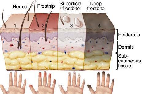 Frostbite Superficial- Normal skin color, large blisters (serous or white), intact pinprick, skin